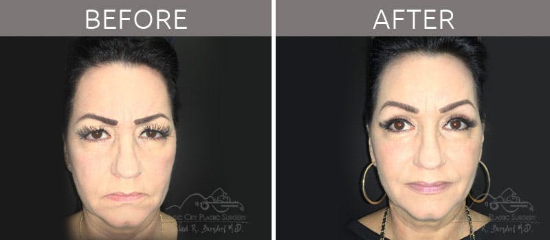 Blepharoplasty Before & After Gallery - Patient 90705118 - Image 1