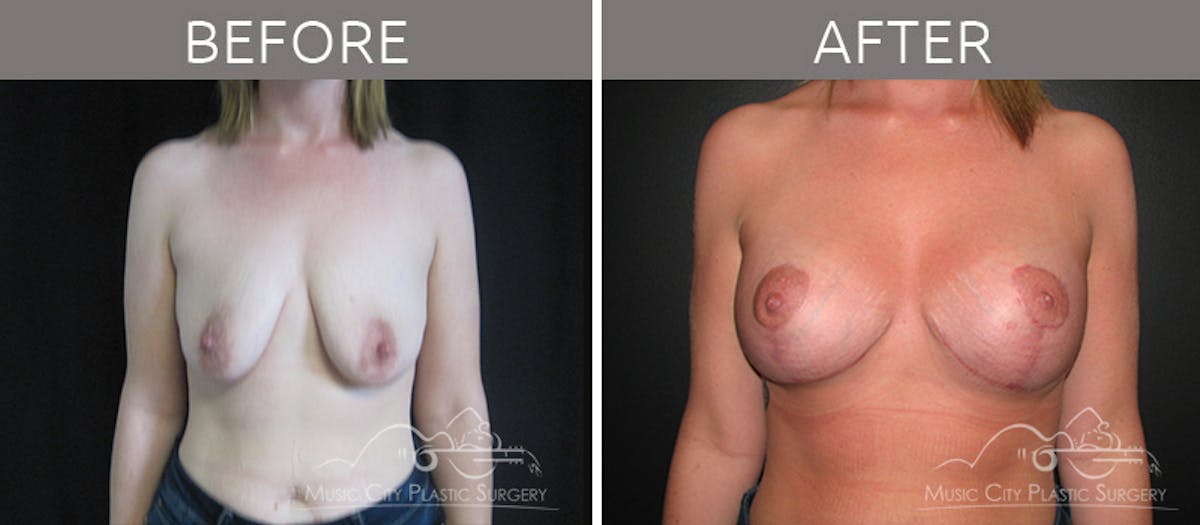 Breast Lift with Augmentation Before & After Gallery - Patient 132099629 - Image 1
