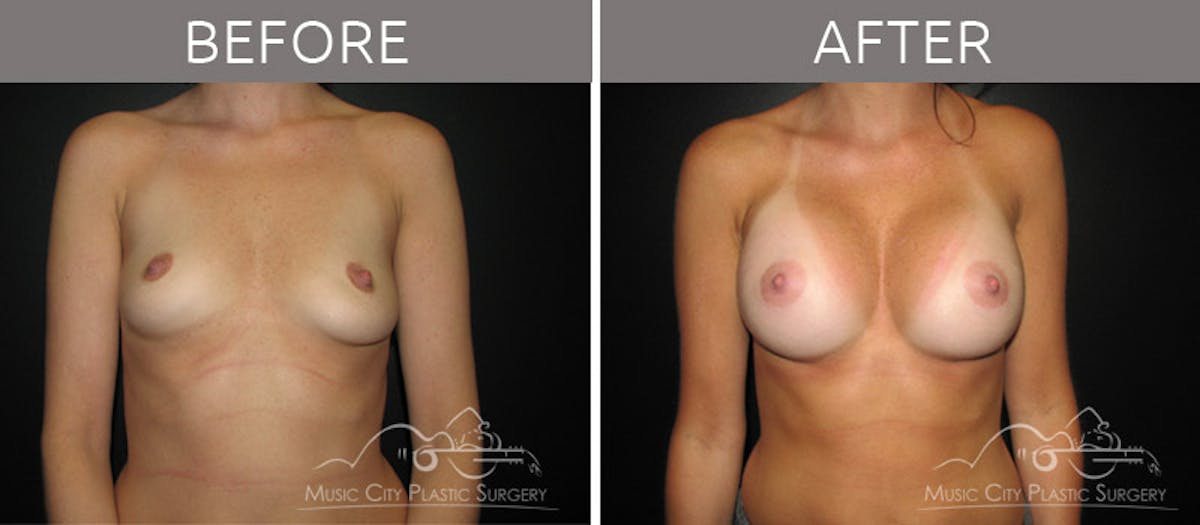 Breast Augmentation Before & After Gallery - Patient 90705116 - Image 1