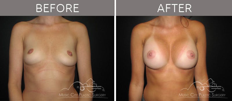 Breast Augmentation Before & After Gallery - Patient 90705116 - Image 3
