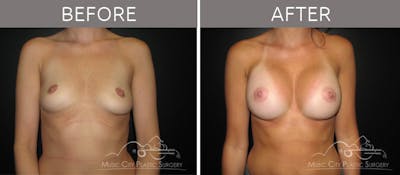 Breast Augmentation Before & After Gallery - Patient 90705116 - Image 3