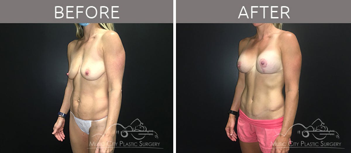 Mommy Makeover Before & After Gallery - Patient 90705129 - Image 2