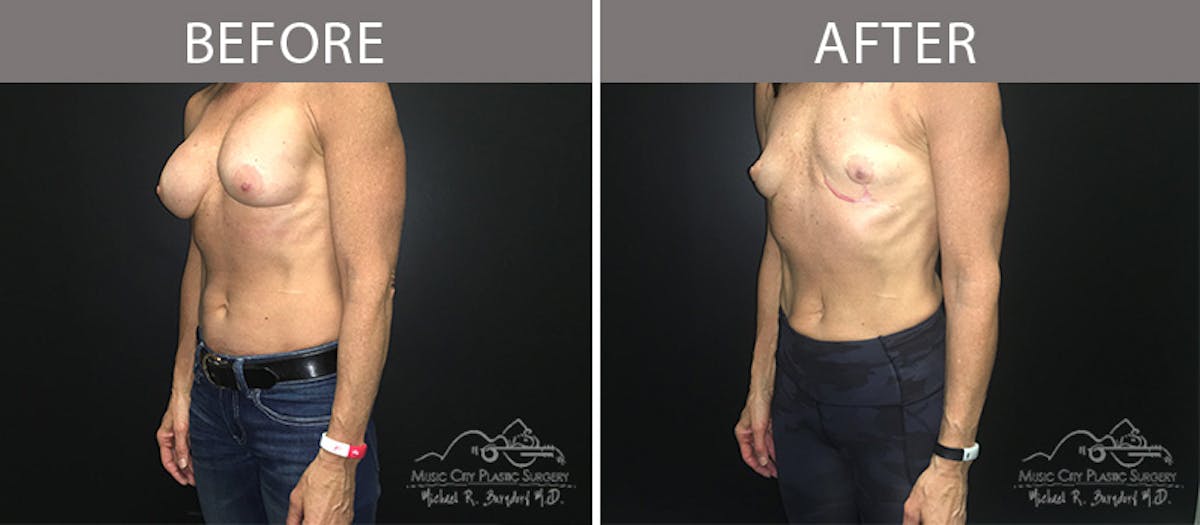 Capsulectomy Before & After Gallery - Patient 90705130 - Image 2