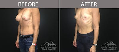 Capsulectomy Before & After Gallery - Patient 90705130 - Image 2