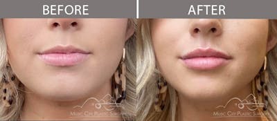 Dermal Fillers Before & After Gallery - Patient 90705119 - Image 1