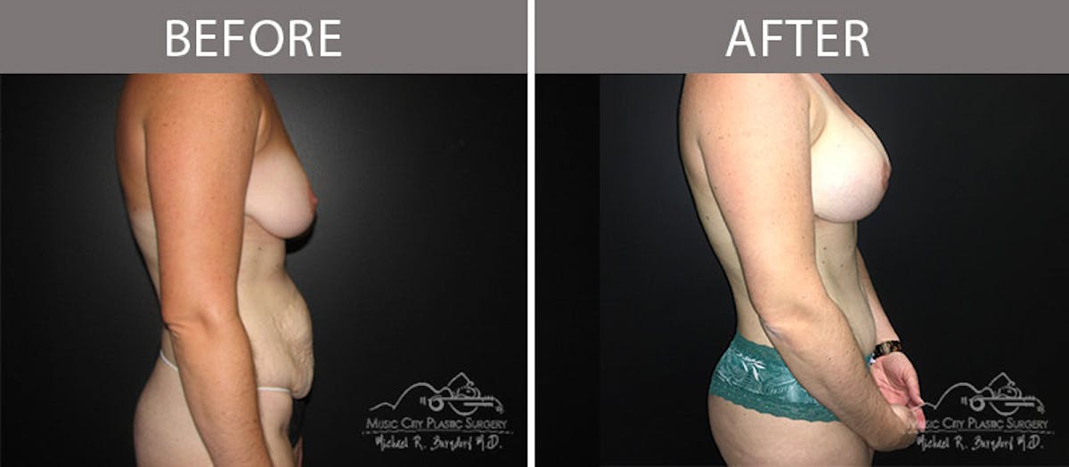 Abdominoplasty Before & After Gallery - Patient 90705131 - Image 3