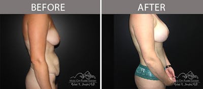 Abdominoplasty Before & After Gallery - Patient 90705131 - Image 1