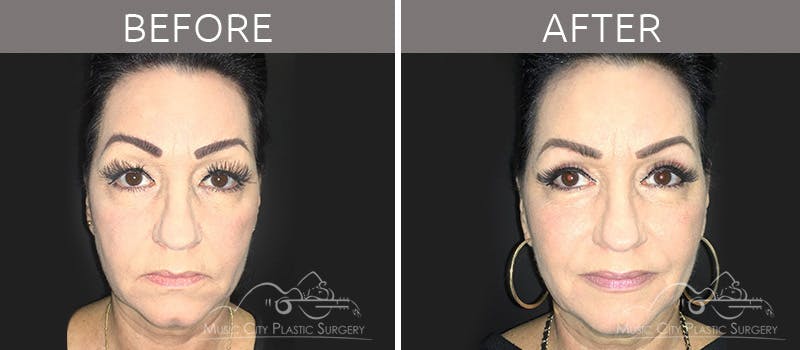 Blepharoplasty Before & After Gallery - Patient 90705118 - Image 2