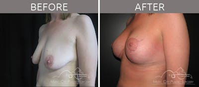 Breast Lift with Augmentation Before & After Gallery - Patient 132099629 - Image 2