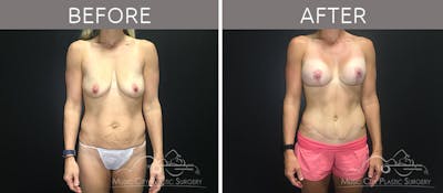 Mommy Makeover Before & After Gallery - Patient 90705129 - Image 1