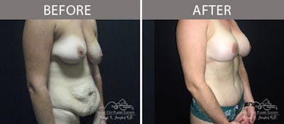 Abdominoplasty Before & After Gallery - Patient 90705131 - Image 2