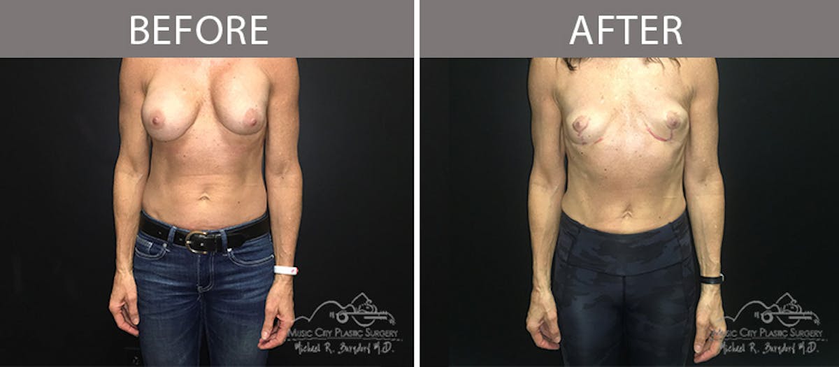 Capsulectomy Before & After Gallery - Patient 90705130 - Image 1