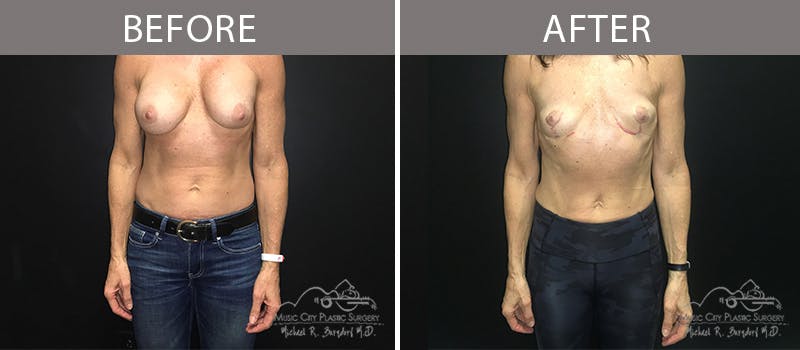 Capsulectomy Before & After Gallery - Patient 90705130 - Image 3