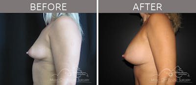 Breast Augmentation Before & After Gallery - Patient 90705135 - Image 3