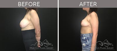 Breast Reduction Before & After Gallery - Patient 90705136 - Image 1