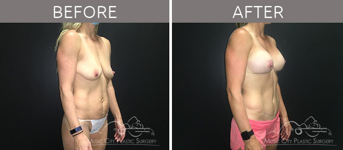 Mommy Makeover Before & After Gallery - Patient 90705129 - Image 4