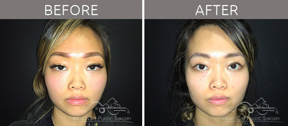 Blepharoplasty Before & After Gallery - Patient 90705122 - Image 1
