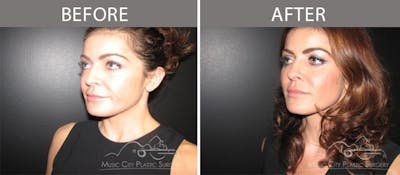 Dermal Fillers Before & After Gallery - Patient 90705123 - Image 1