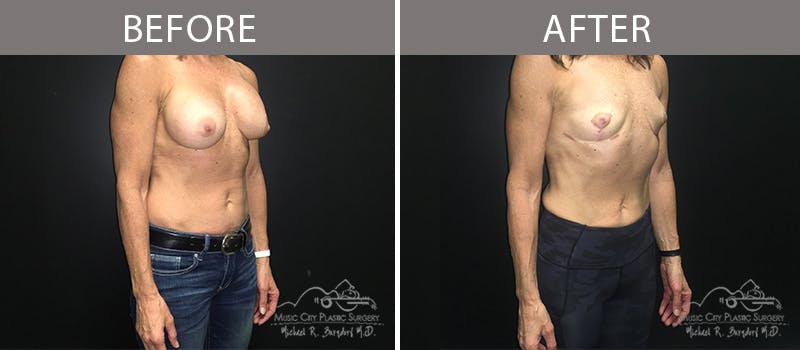 Capsulectomy Before & After Gallery - Patient 90705130 - Image 4