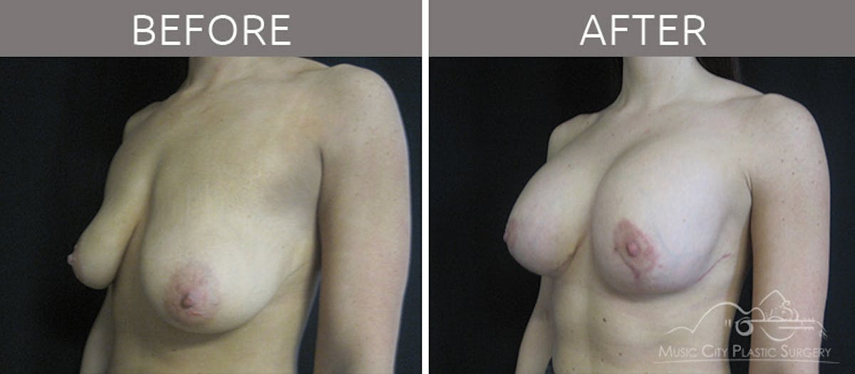 Breast Lift Before & After Gallery - Patient 90705137 - Image 2