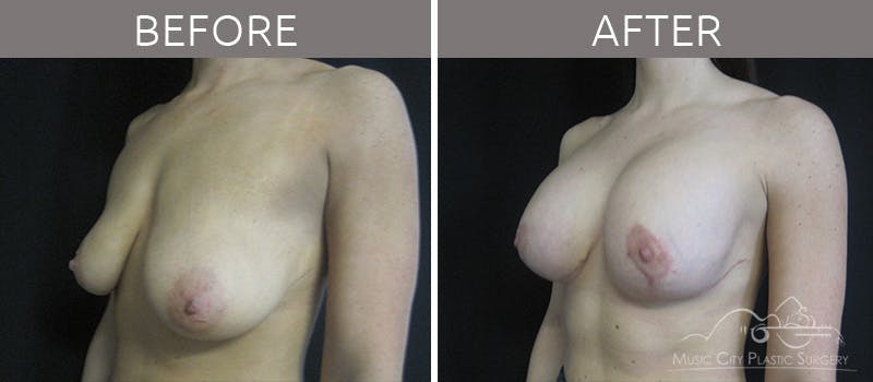 Breast Lift Before & After Gallery - Patient 90705137 - Image 1
