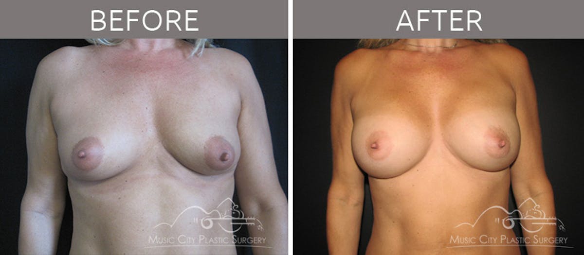 Breast Augmentation Before & After Gallery - Patient 90705135 - Image 1