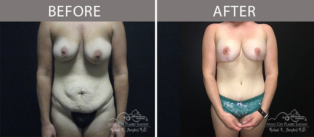 Abdominoplasty Before & After Gallery - Patient 90705131 - Image 1