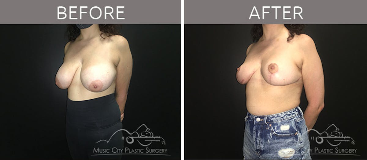 Breast Reduction Before & After Gallery - Patient 90705136 - Image 2