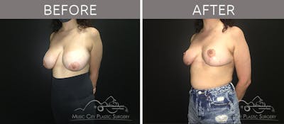 Breast Reduction Before & After Gallery - Patient 90705136 - Image 2