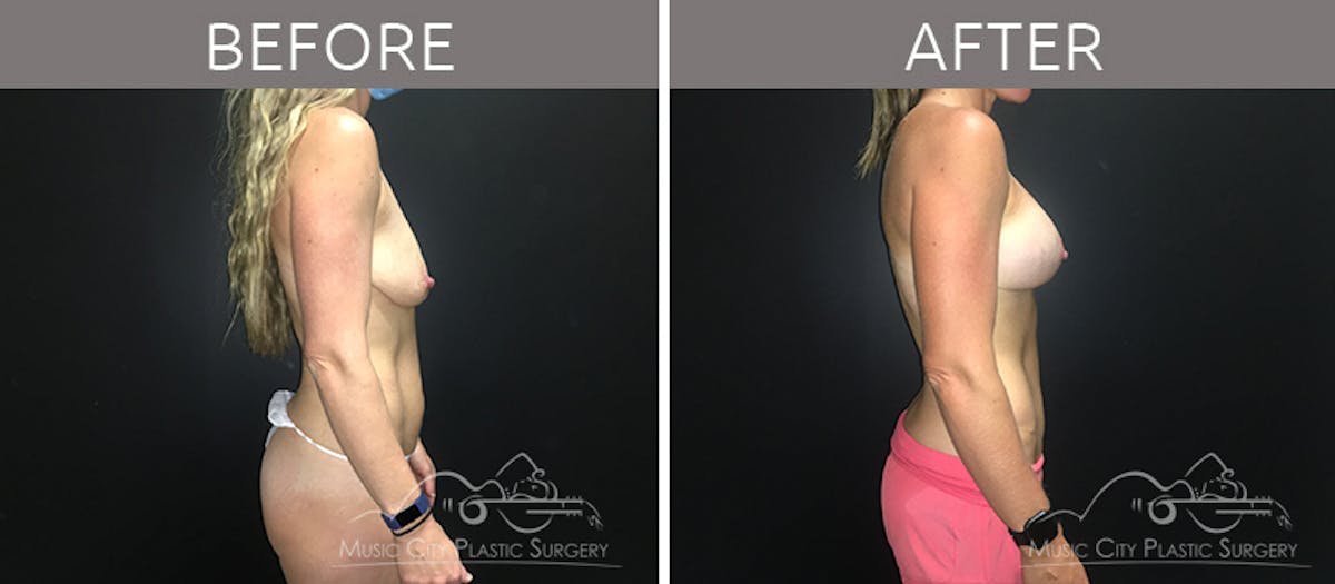 Mommy Makeover Before & After Gallery - Patient 90705129 - Image 5