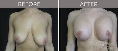 Breast Lift Before & After Gallery - Patient 90705137 - Image 1