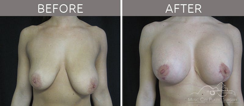 Breast Lift Before & After Gallery - Patient 90705137 - Image 2