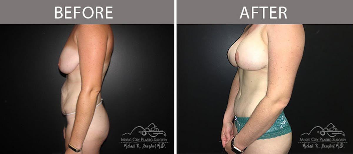 Abdominoplasty Before & After Gallery - Patient 90705131 - Image 4