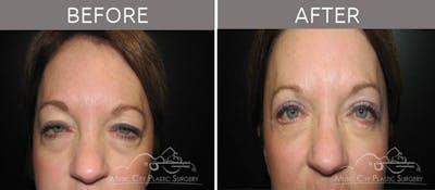 Blepharoplasty Before & After Gallery - Patient 90705132 - Image 1
