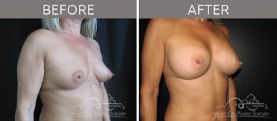 Breast Augmentation Before & After Gallery - Patient 90705135 - Image 2