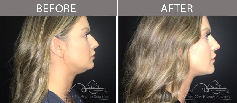Dermal Fillers Before & After Gallery - Patient 90705138 - Image 1
