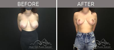 Breast Reduction Before & After Gallery - Patient 90705136 - Image 1