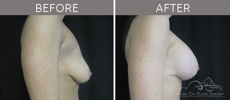 Breast Lift Before & After Gallery - Patient 90705137 - Image 3