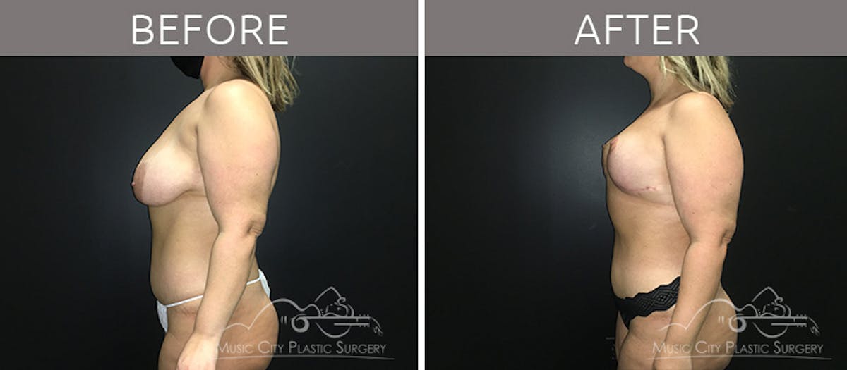 Mommy Makeover Before & After Gallery - Patient 90705147 - Image 3