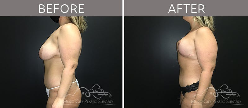 Mommy Makeover Before & After Gallery - Patient 90705147 - Image 1