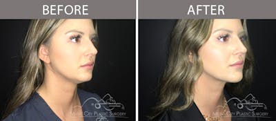 Dermal Fillers Before & After Gallery - Patient 90705138 - Image 2