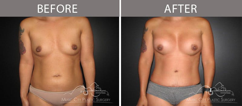 Abdominoplasty Before & After Gallery - Patient 90705140 - Image 1