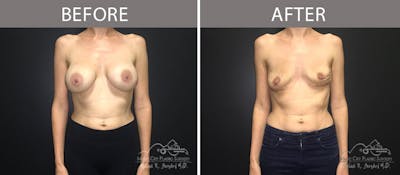 Capsulectomy Before & After Gallery - Patient 90705143 - Image 1