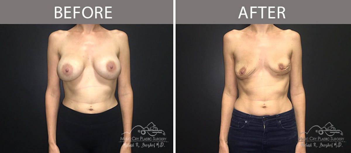 Capsulectomy Before & After Gallery - Patient 90705143 - Image 1