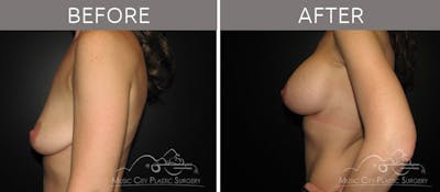 Breast Augmentation Before & After Gallery - Patient 90705149 - Image 3
