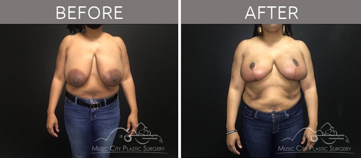 Breast Reduction Before & After Gallery - Patient 90705139 - Image 1