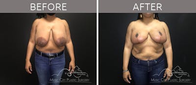 Breast Reduction Before & After Gallery - Patient 90705139 - Image 1