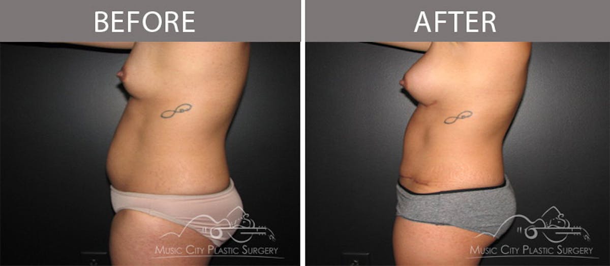 Abdominoplasty Before & After Gallery - Patient 90705140 - Image 2