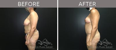 Breast Reduction with Lift Before & After Gallery - Patient 132099792 - Image 3