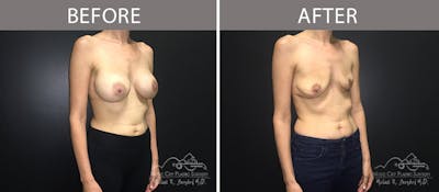 Capsulectomy Before & After Gallery - Patient 90705143 - Image 2